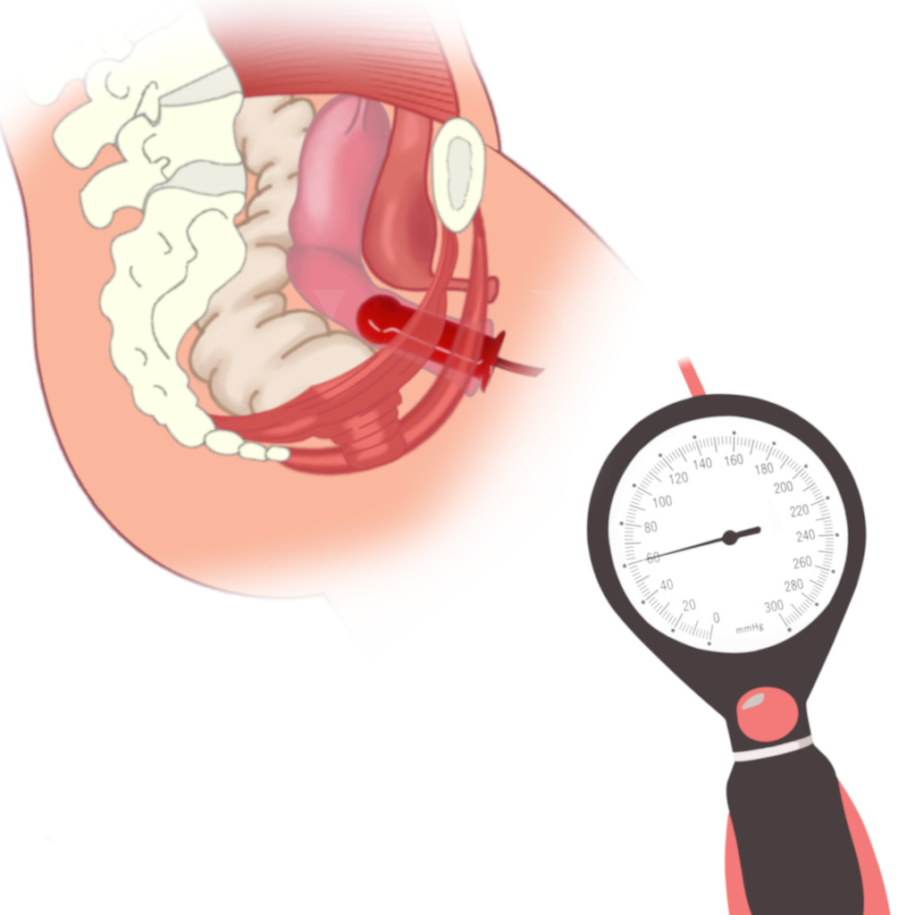 Exercices de Kegel avec l'appareil Kegel Air, principe de fonctionnement